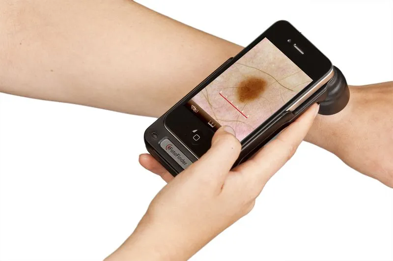The handyscope digital dermascope accessory for iPhone