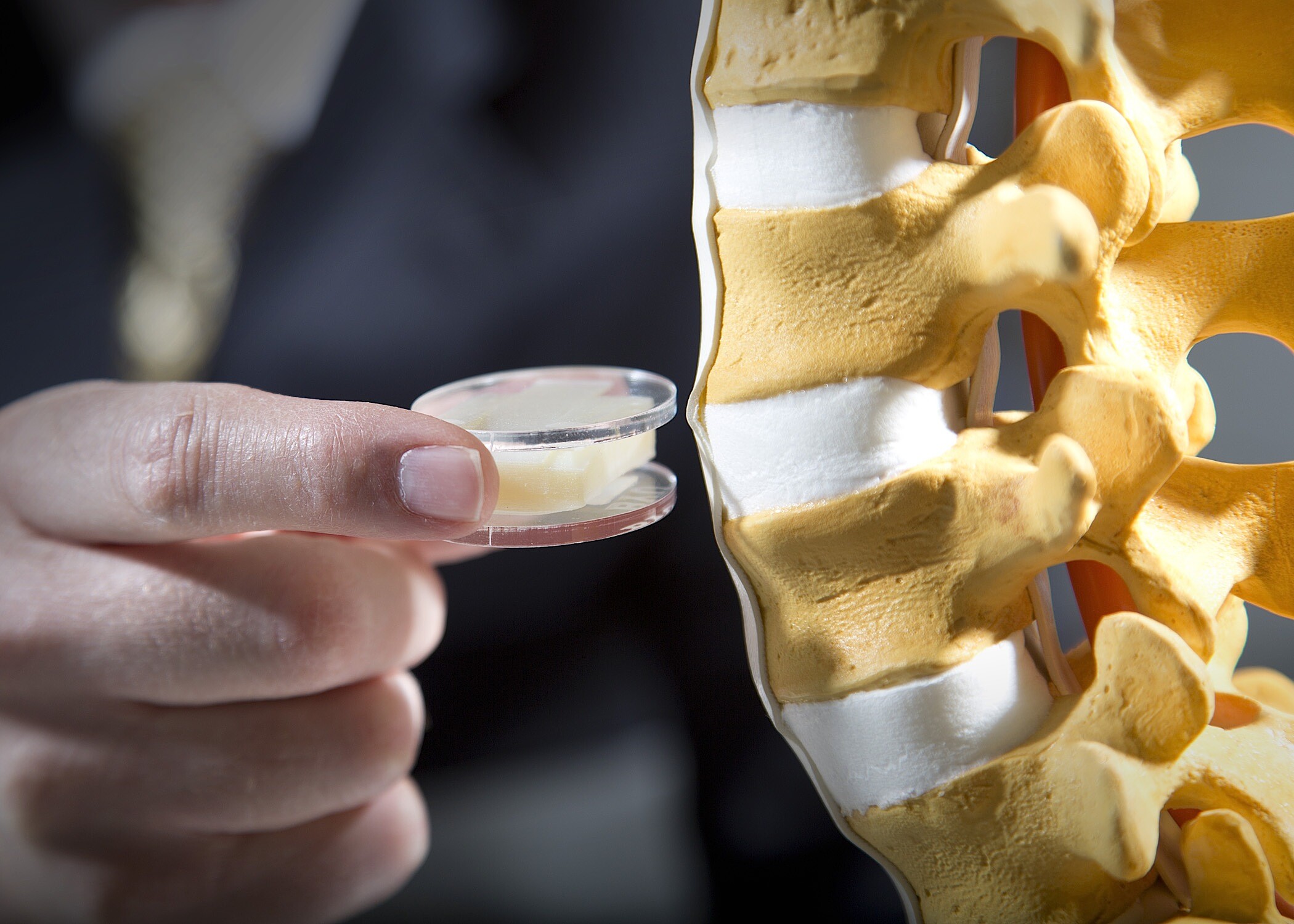 Artificial spinal disc designed to treat chronic lower back pain