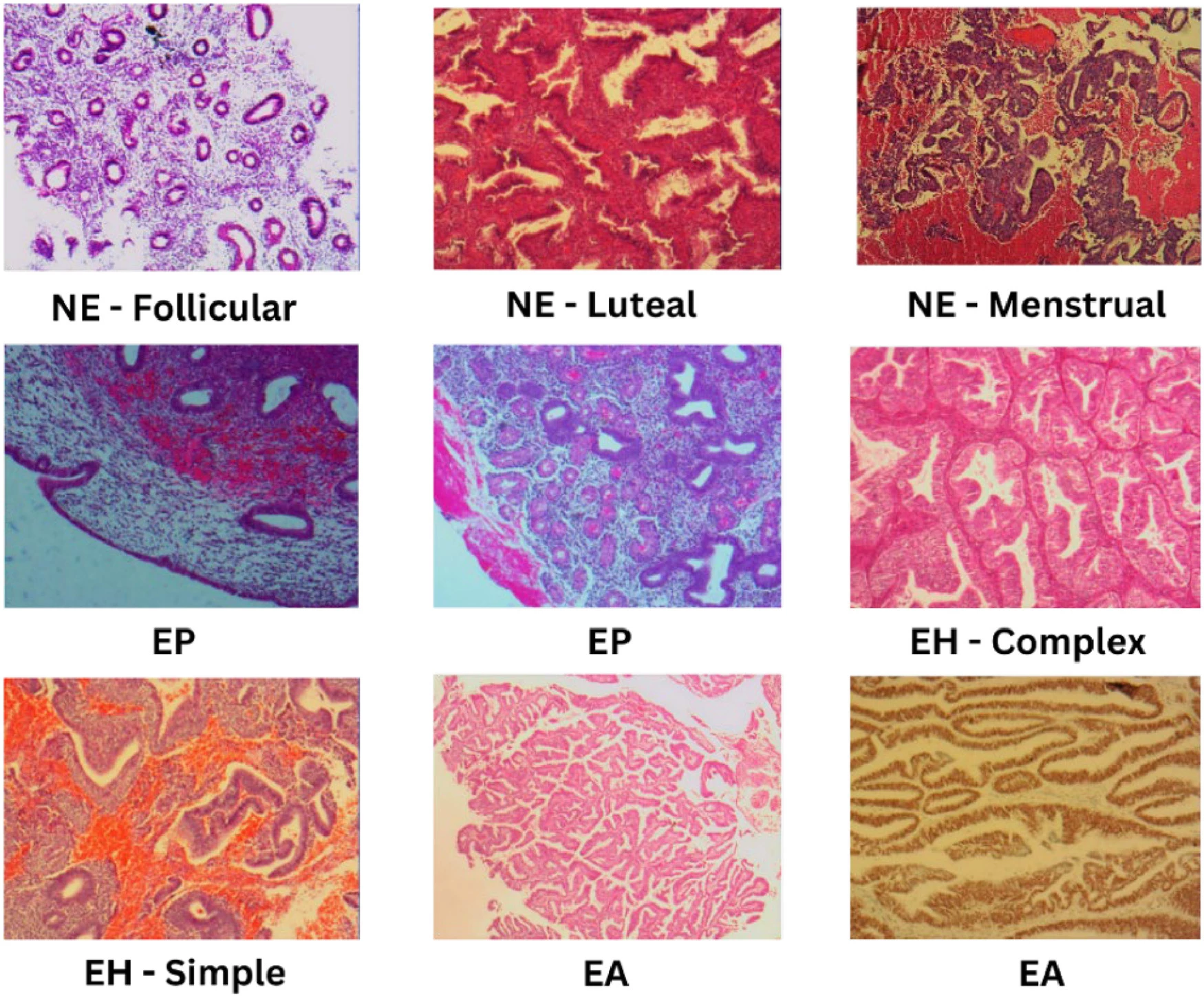 Sample images of the dataset the AI was trained on featuring normal endometrium (NE), endometrial polyp (NP), endometrial hyperplasia (EH) and endometrial adenocarcinoma (EA)