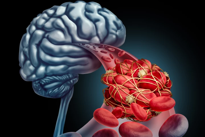 A new treatment for stroke is still deeply experimental and yet to proceed to human testing