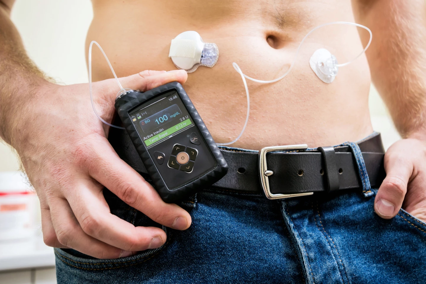 An automated insulin delivery (AID) system comprises an insulin pump and continuous glucose monitoring (CGM)