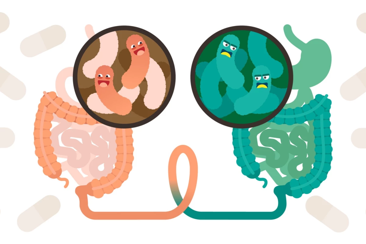 Despite no weight loss noted during the treatment period, a study into FMT to treat obesity did uncover certain microbiome changes occurring in the subjects receiving the fecal transplants