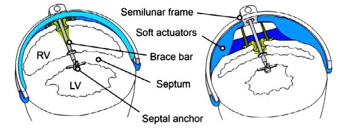 A diagram showing how the device helps draw blood in (left) and push it out (right)