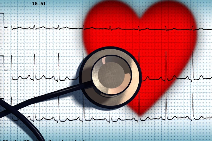 A study following more than 250,000 people has confirmed an association between atrial fibrillation and the onset of dementia