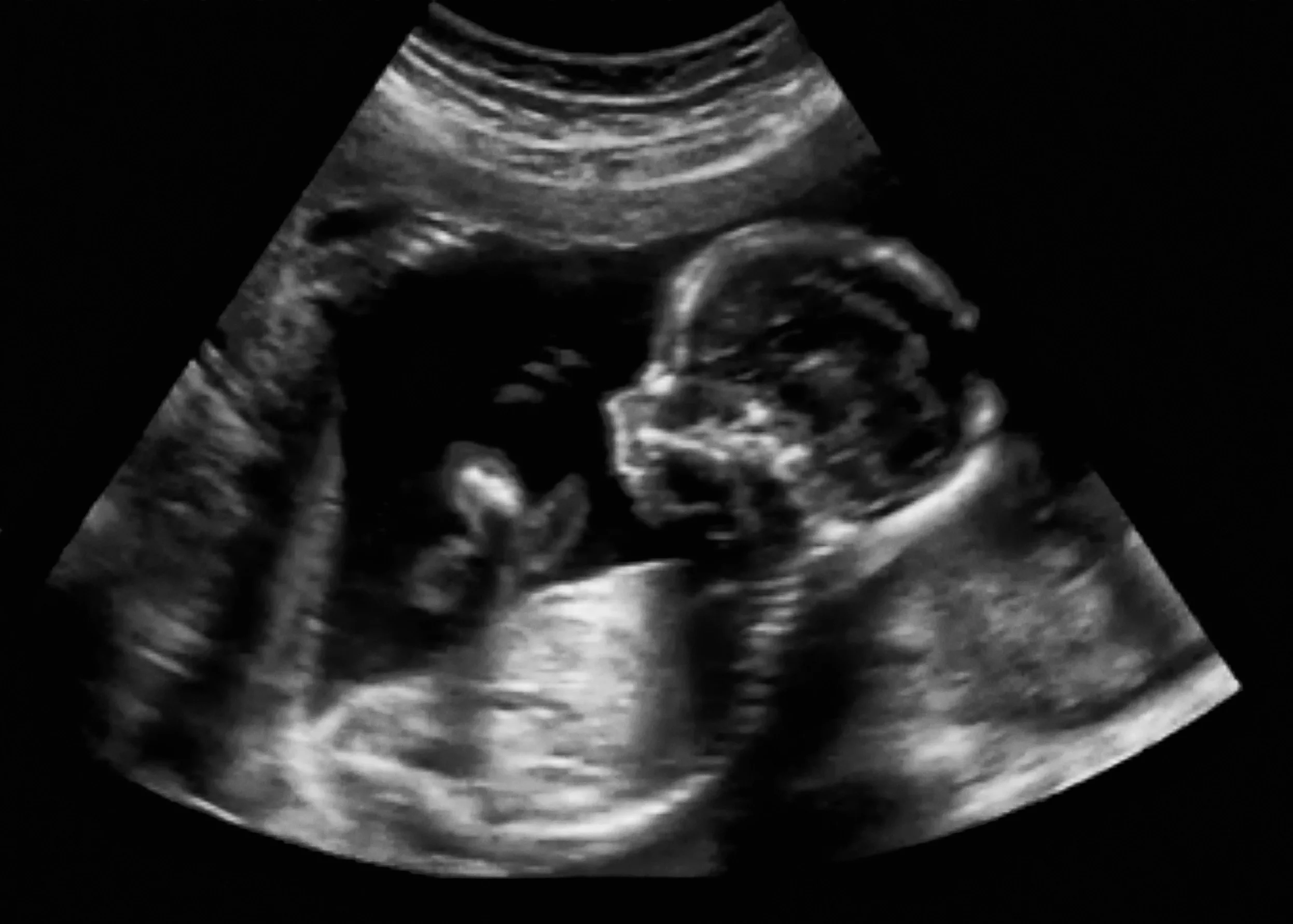 Scientists have treated an often fatal genetic condition in the womb for the first time