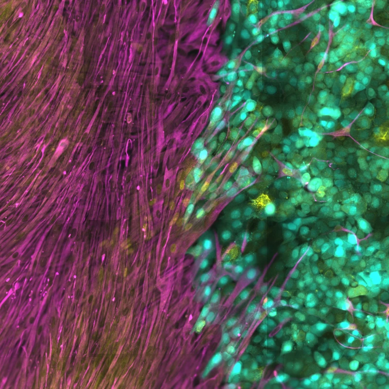 Image showing cancer-associated fibroblasts in magenta, interacting with with cancer cells seen in cyan