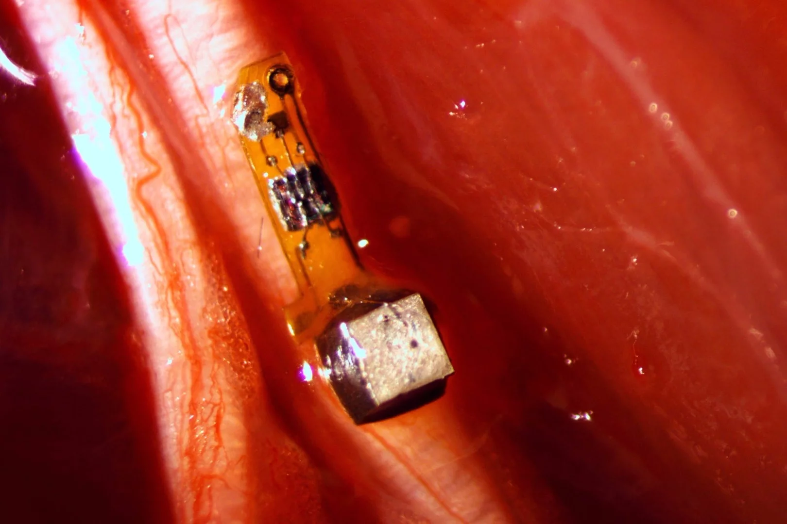 Neural Dust consists of tiny wireless sensors designed to go inside the body and track nerve signals and muscles in real-time