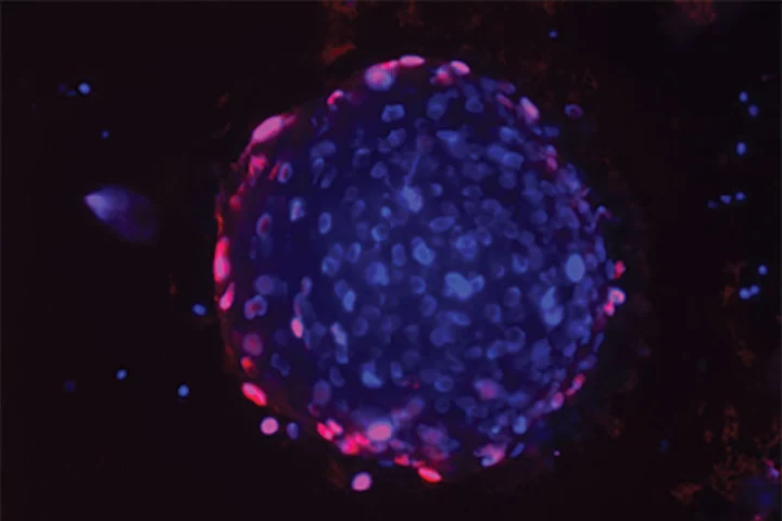 A microscope image of a human prostate cancer organoid, being treated with the new drug. The red areas indicate dead cells