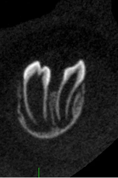 A split tooth germ developing