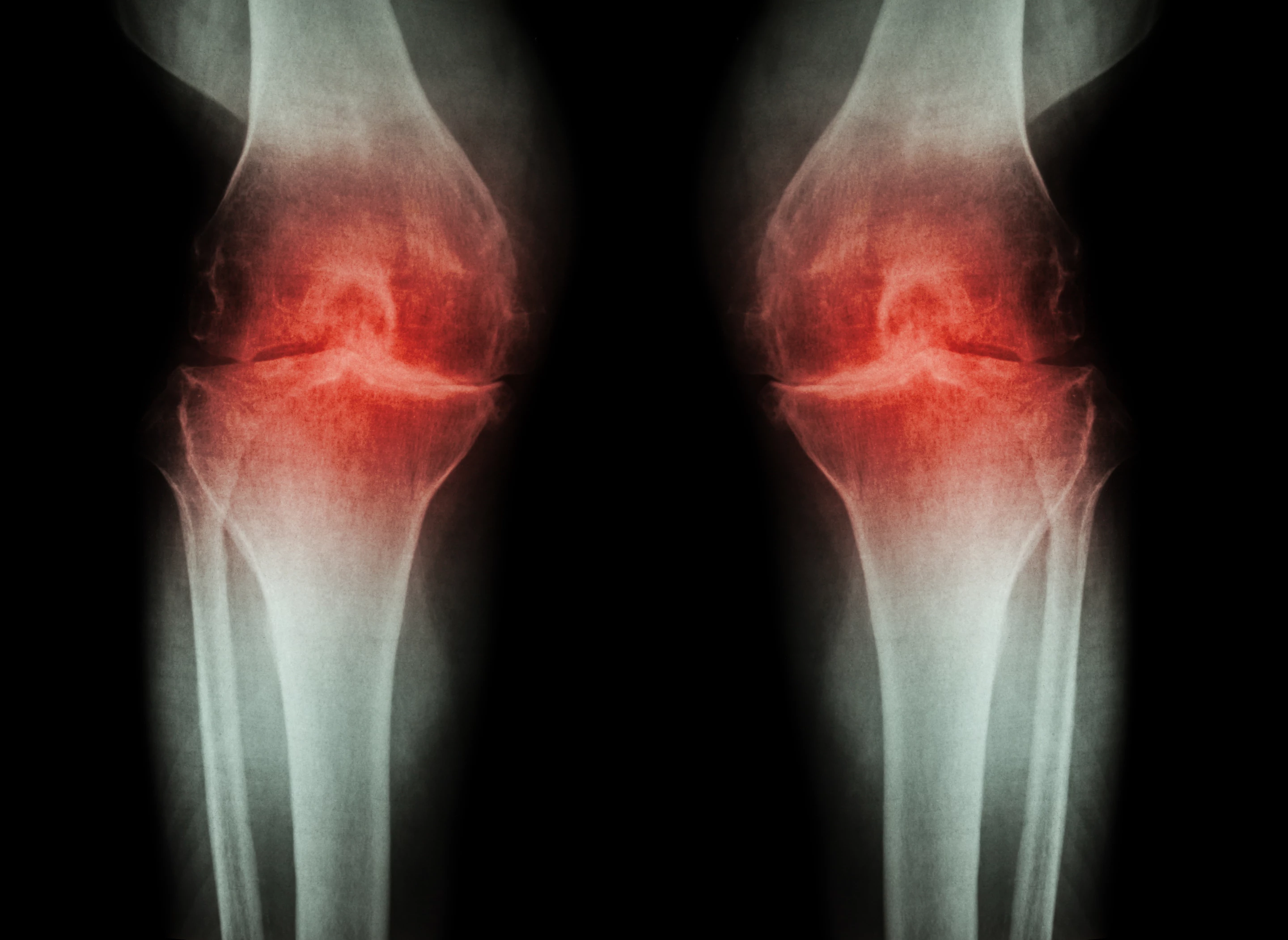 New research has found long-term use of common anti-inflammatory pain relievers did not lead to improvements in inflammatory signs of osteoarthritis