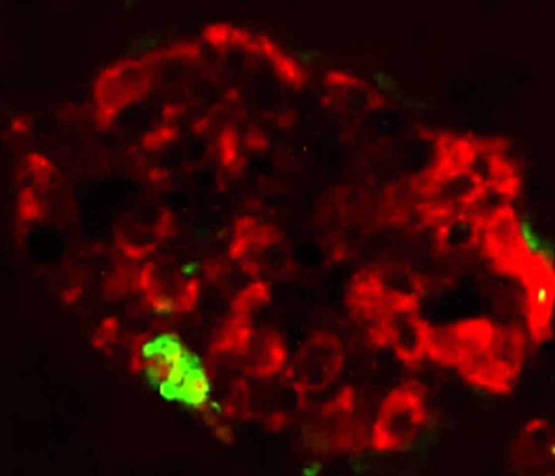 A large protein aggregate (green) forms in a pancreatic islet (red) from a transgenic mouse injected with extract containing misfolded IAPP