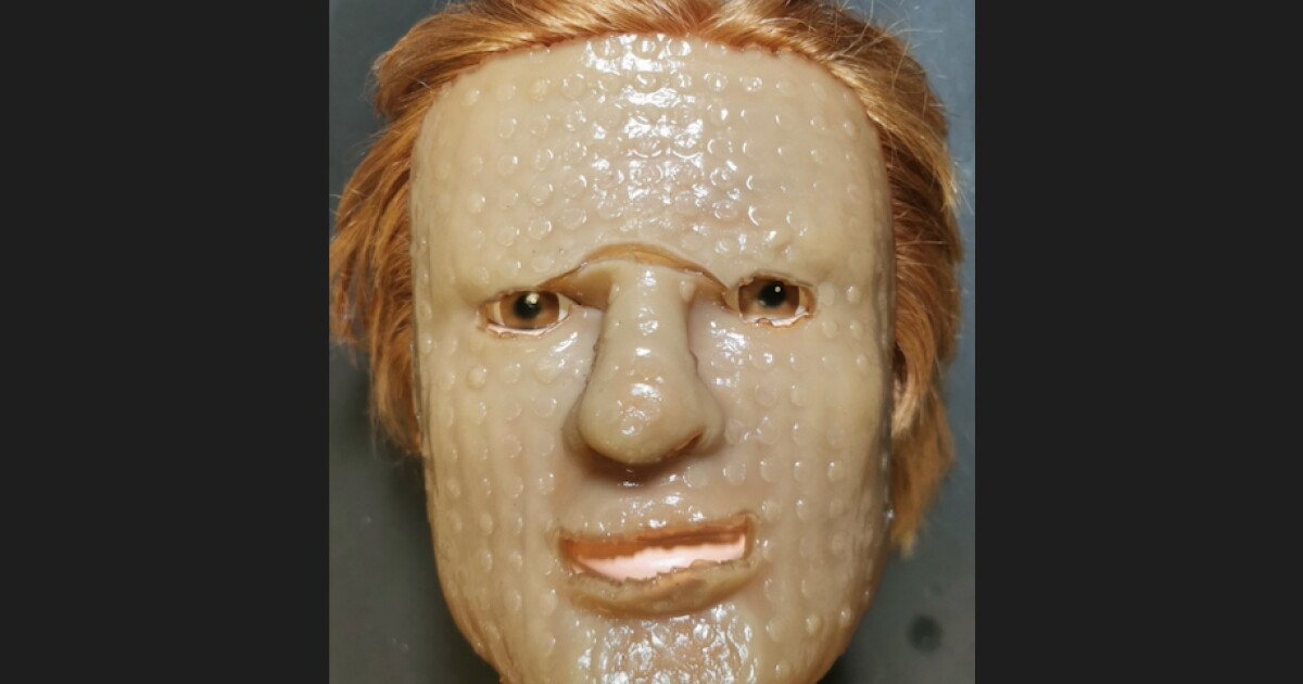 Temperature-sensitive dressing could revolutionize burn treatment Temperature-sensitive dressing could revolutionize burn treatment