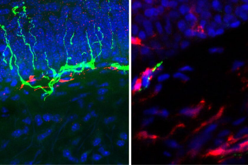 Skin biopsies of healthy patients (left) show plenty of sensory nerve fibers (green) with few macrophages (red), while patients with diabetic neuropathy (right) have the opposite