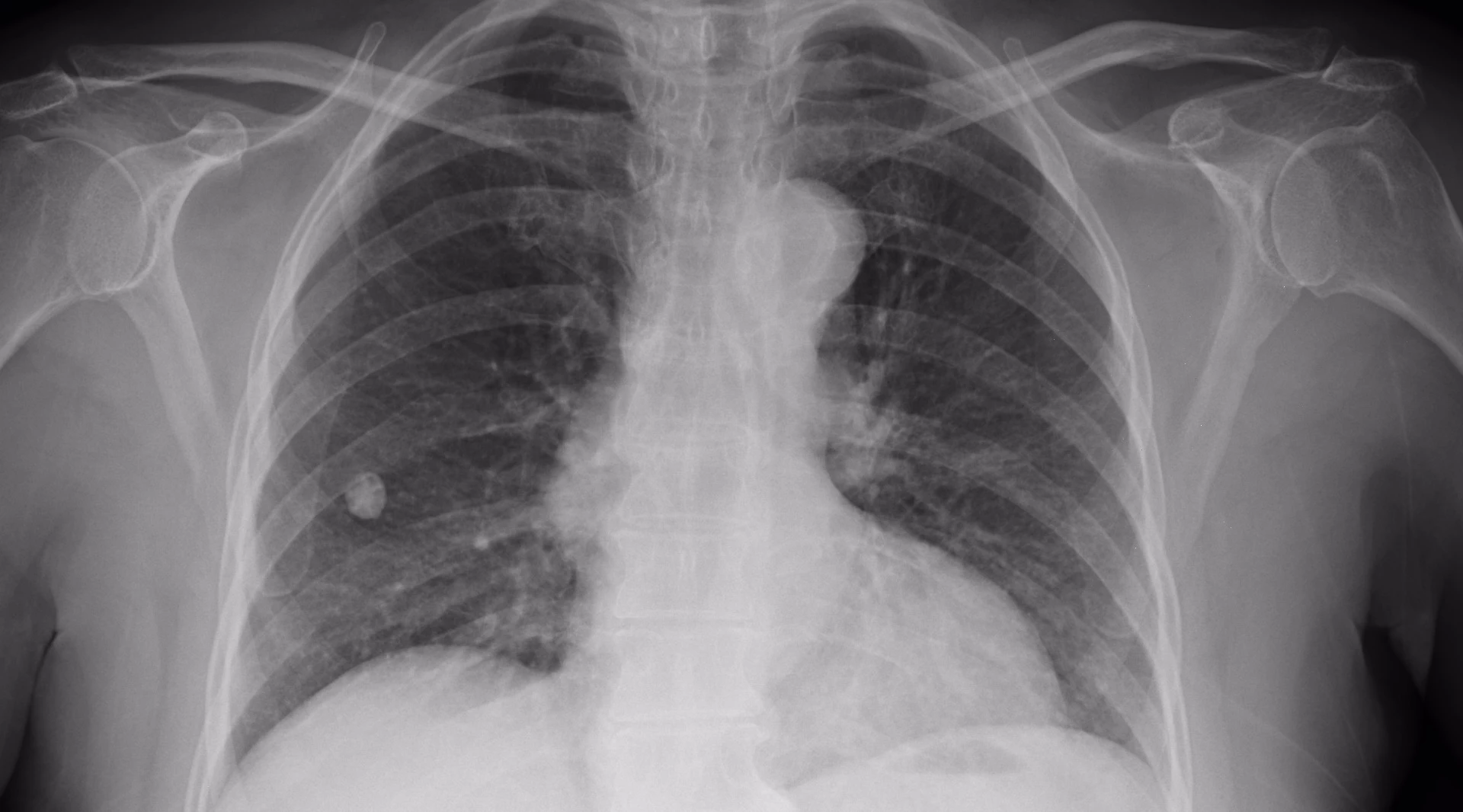 Chinese radiologists look at hundreds of medical images every day. Infervision hopes to use AI and deep learning to dramatically speed up the repetitive work of detecting lung cancer in its early stages