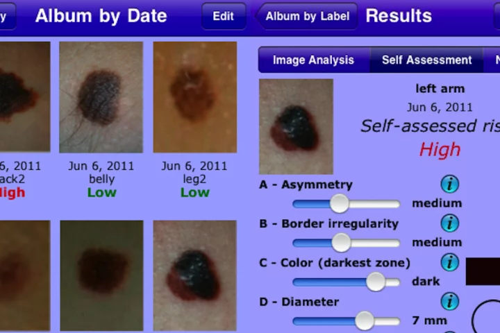 MelApp is an image-based risk assessment mobile app that assists in the early detection of melanoma