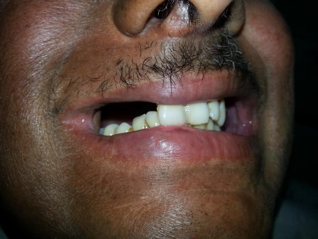 Affecting his eating, speech and appearance, the patient sought a prosthesis but dentists were reluctant to treat him