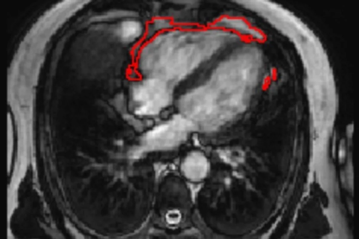 An example of the fat deposits detected by the new tool