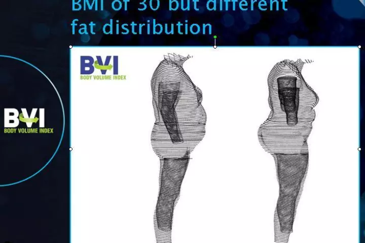The Body Volume Index uses a 3D scanning process to analyze fat distribution