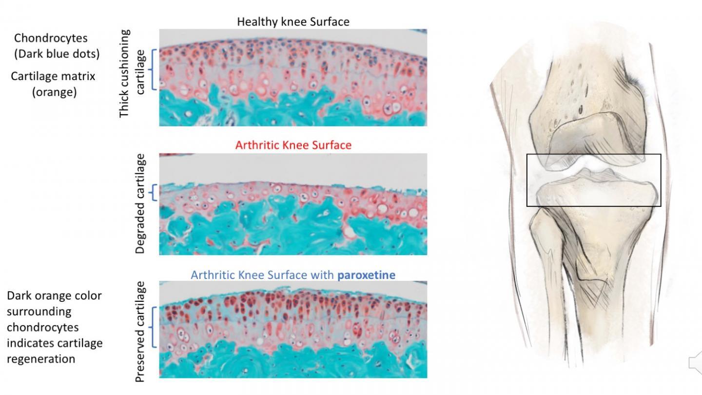 Diagram depicting the potential of anti-depressant paroxetine in treating osteoarthritis