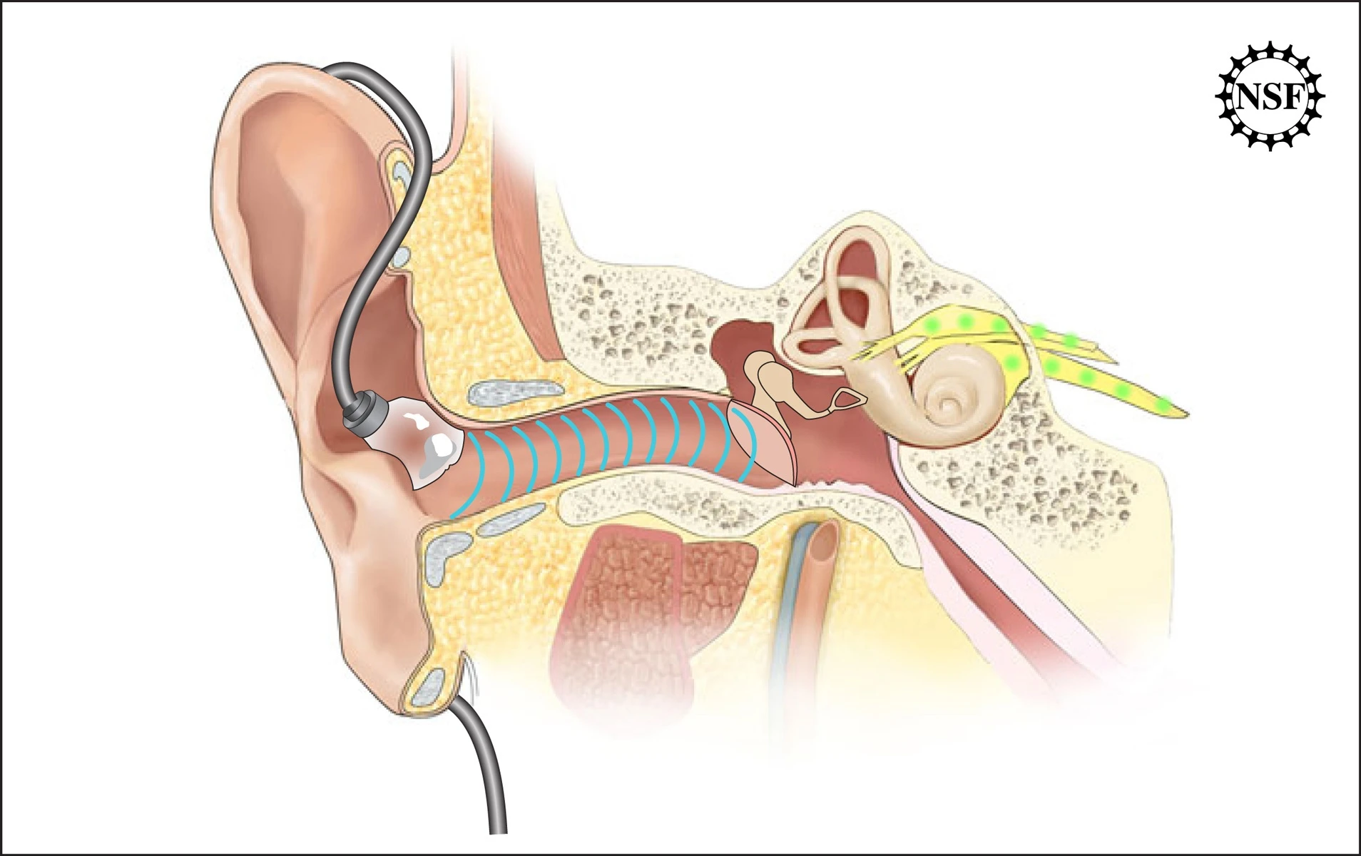 The ADEL features an inflatable tip, that is said to minimize or eliminate discomfort in the ears of music listeners (All images: Asius Technologies)