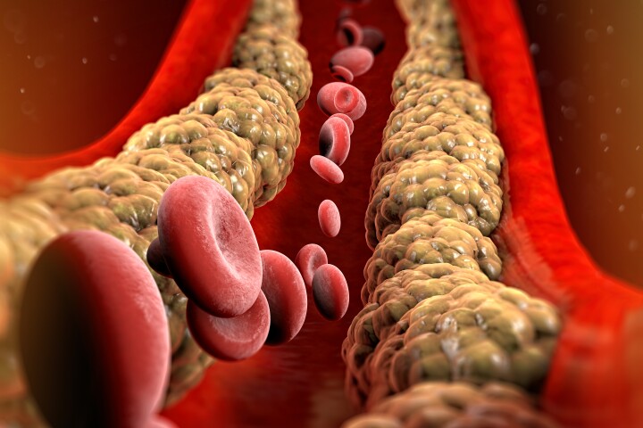 Common problem: One in five people have the genetic potential for elevated Lp(a) levels