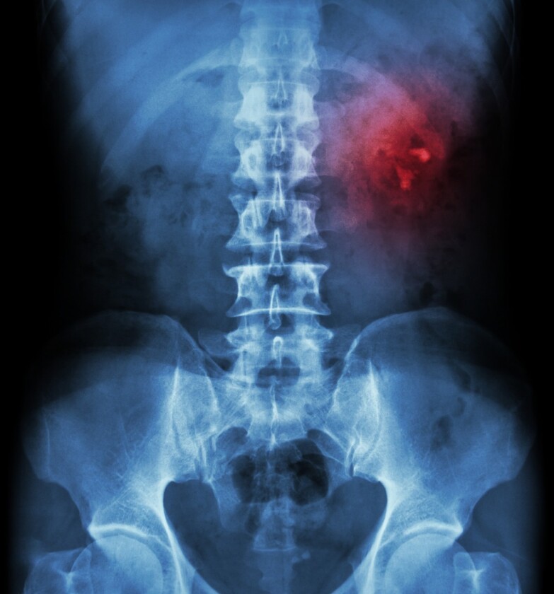 DeepMind scientists have developed an AI system they say can predict a form of kidney failure 48 hours ahead of time