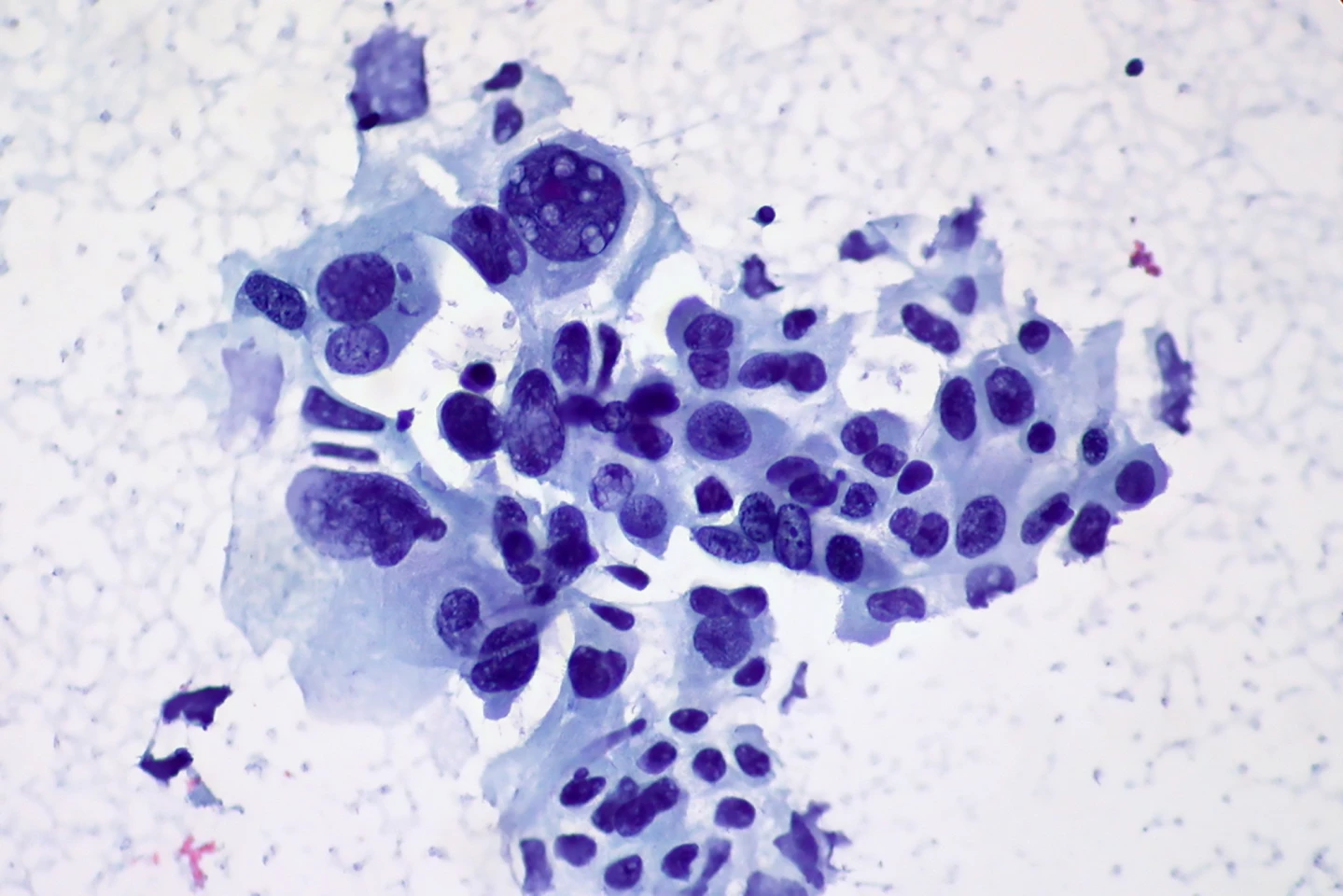 Non-small cell carcinoma