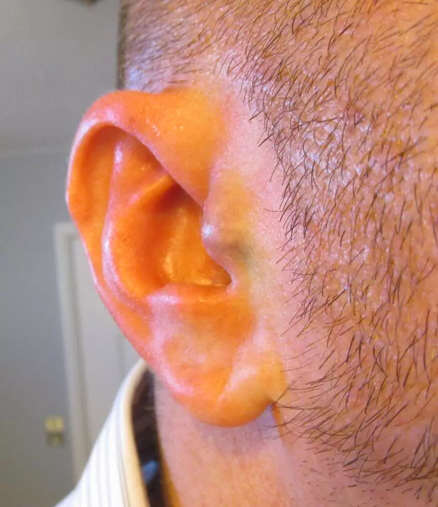 One of the implants in Lee's ear