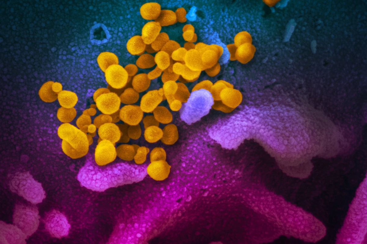 An electron microscope image showing the SARS-CoV-2 virus (yellow)—also known as 2019-nCoV, the coronavirus that causes COVID-19