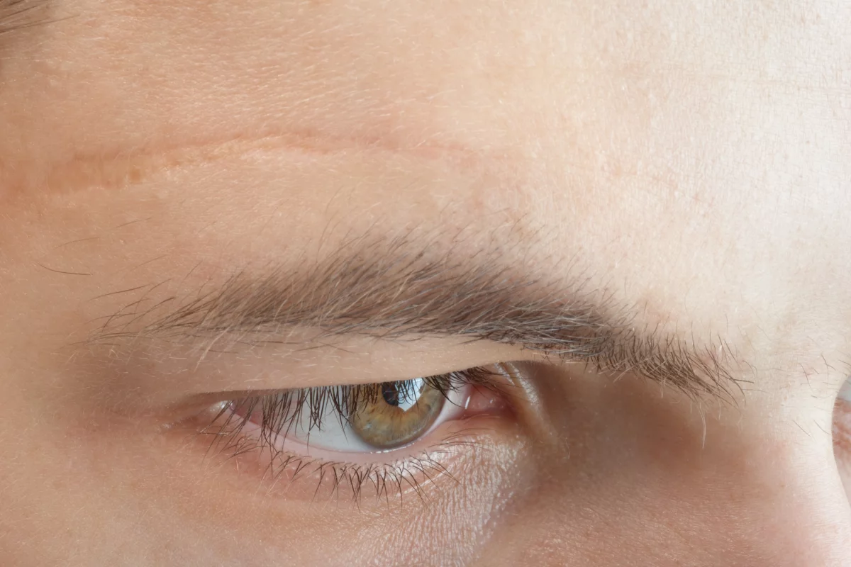 Could scars like this become a thing of the past?