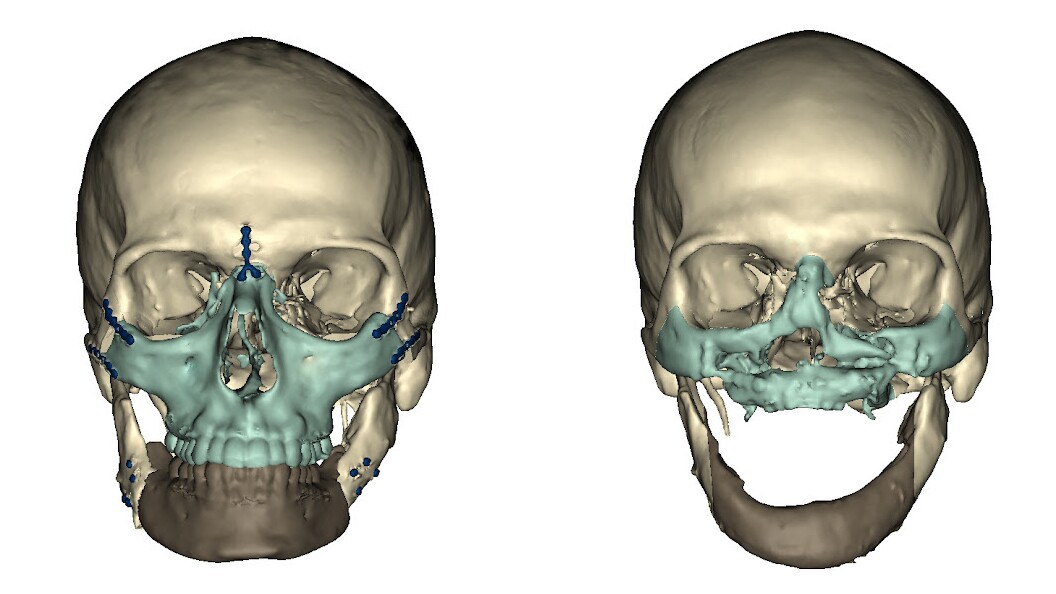 CT scan before and after surgery (Image: University of Maryland Medical Center)