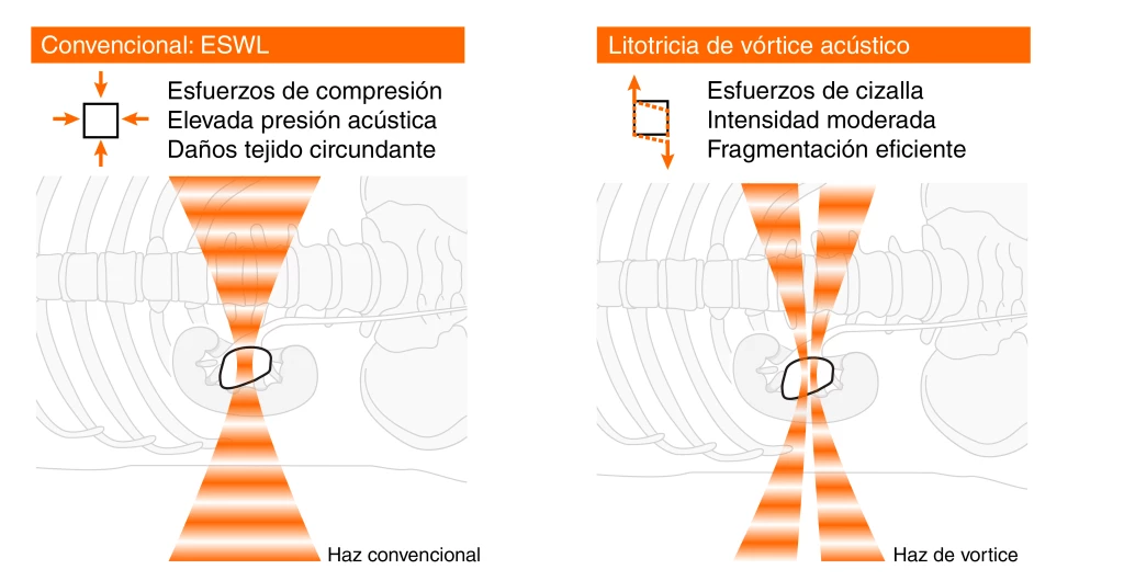 This diagram illustrates the differences between ESWL (left) and the Lithovortex system (right)