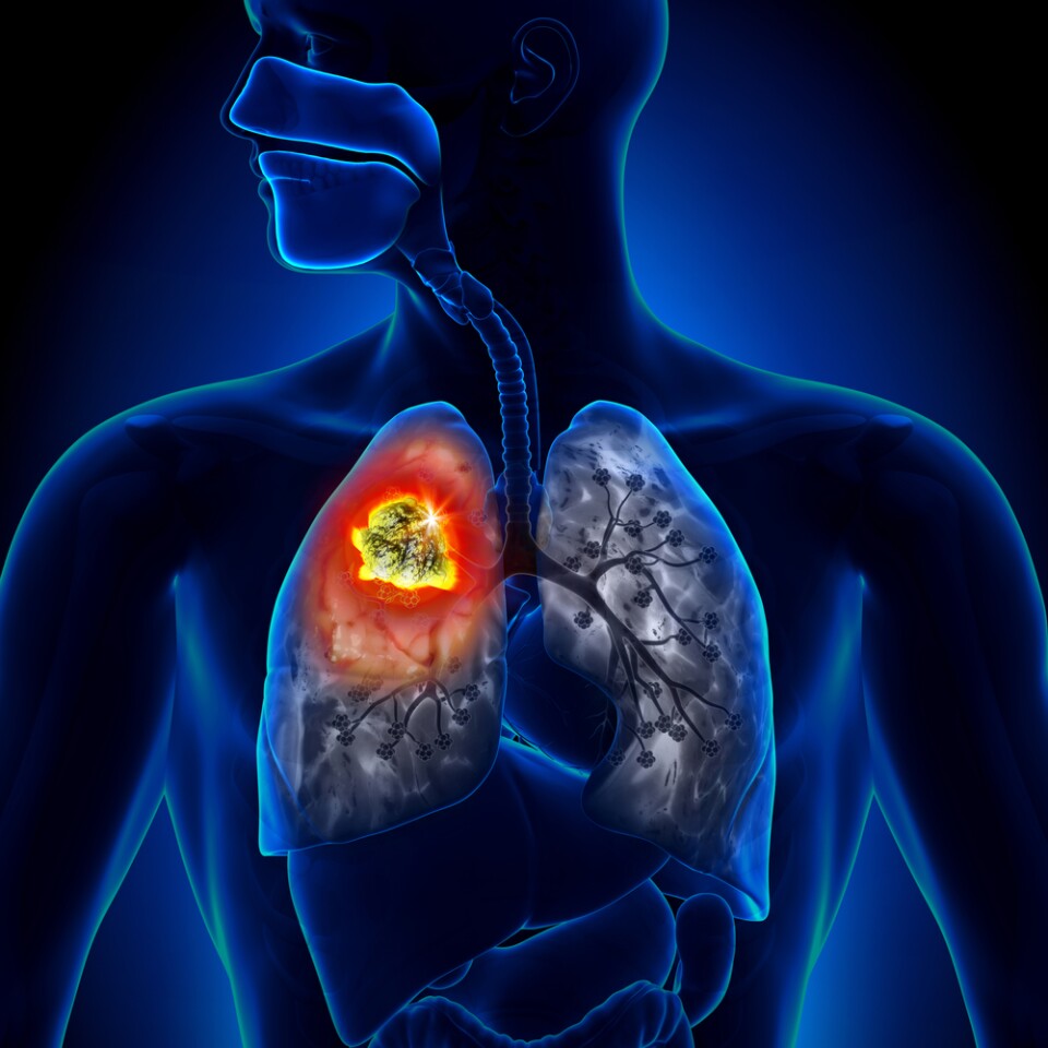 AI systems have outperformed humans at predicting growth of lung cancers