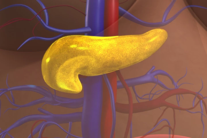 The discovery of microRNAs in the pancreatic cells of type 2 diabetics will guide future studies into the early detection and treatment of the disease