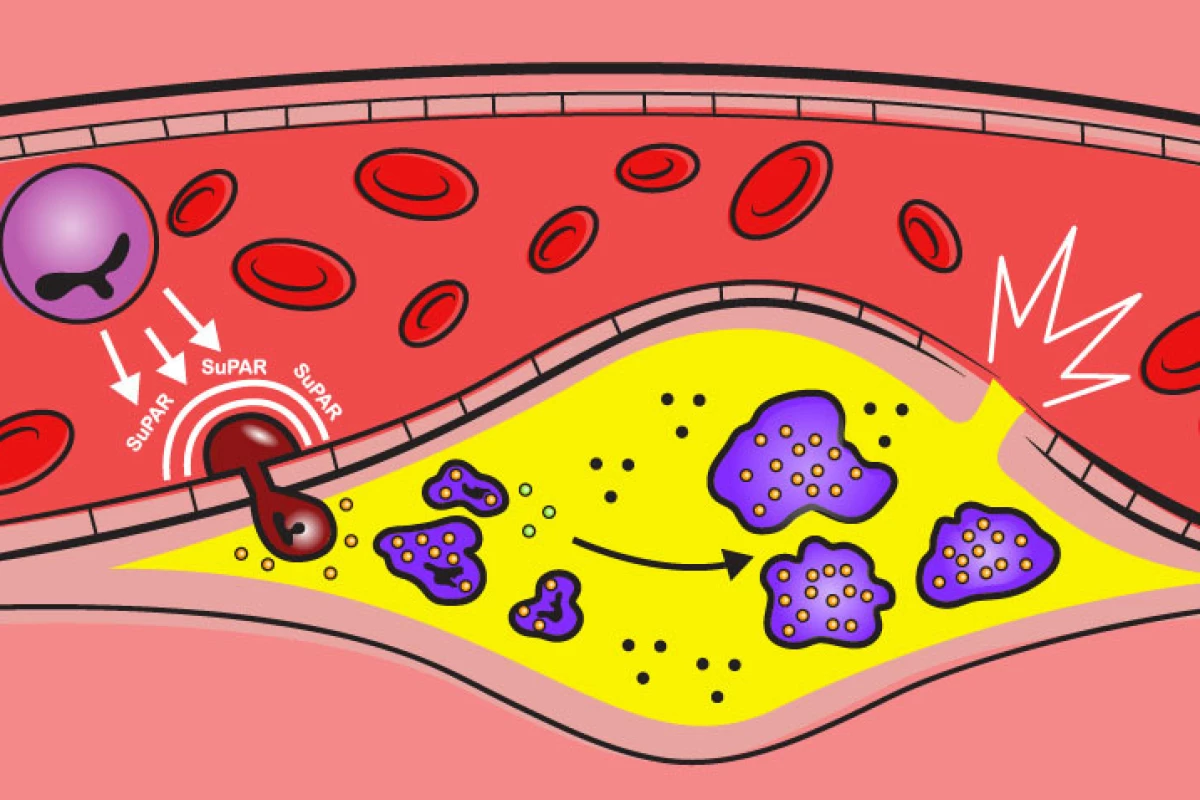 The research reveals an immune protein plays a key role in triggering the build-up of plaques in heart disease