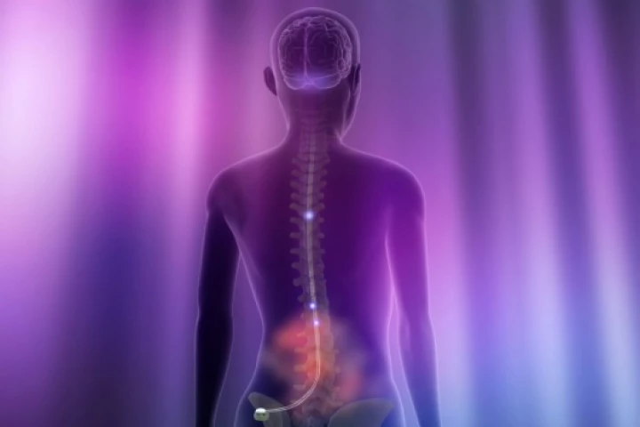 The Eon Mini Spinal Cord Stimulator