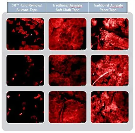 Photos showing the amount of skin damage caused by the removal of the silicone tape, as opposed to conventional tapes (Image: 3M)