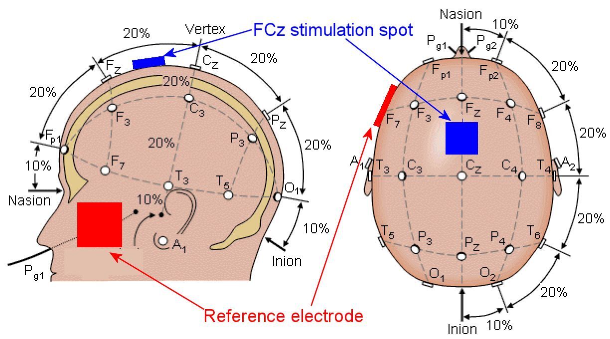 The electrode placement positions for the Vanderbilt study (Image: modified by Author)