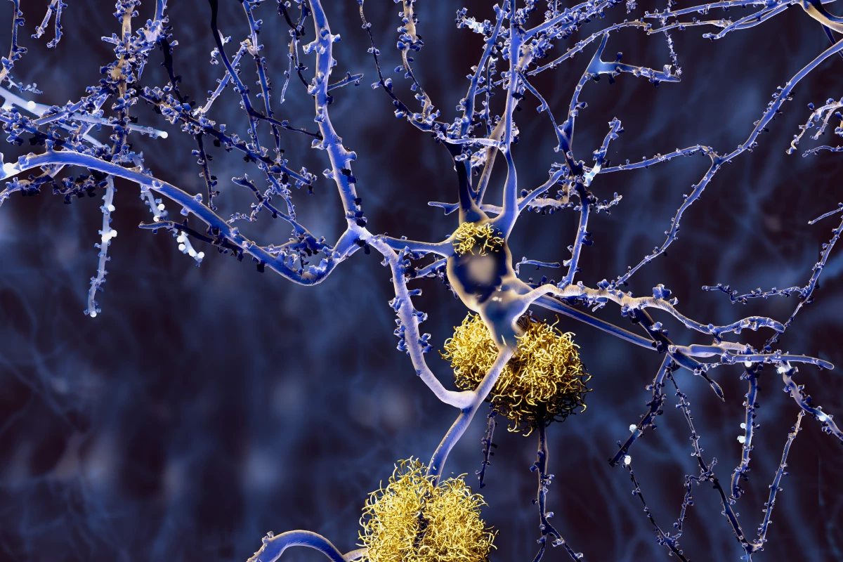 Amyloid-beta plaques in the brain are one of the potential culprits behind Alzheimer's disease