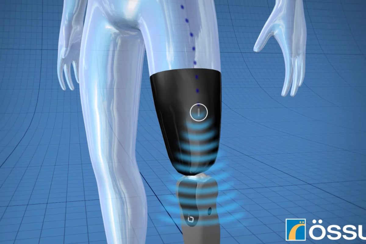 The Ossur system uses implanted sensors sending wireless signals to the artificial limb's built-in computer