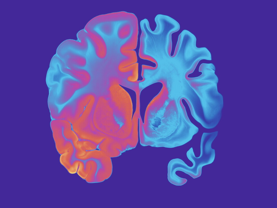 Neuron discovery could explain why some people don't get Alzheimer's