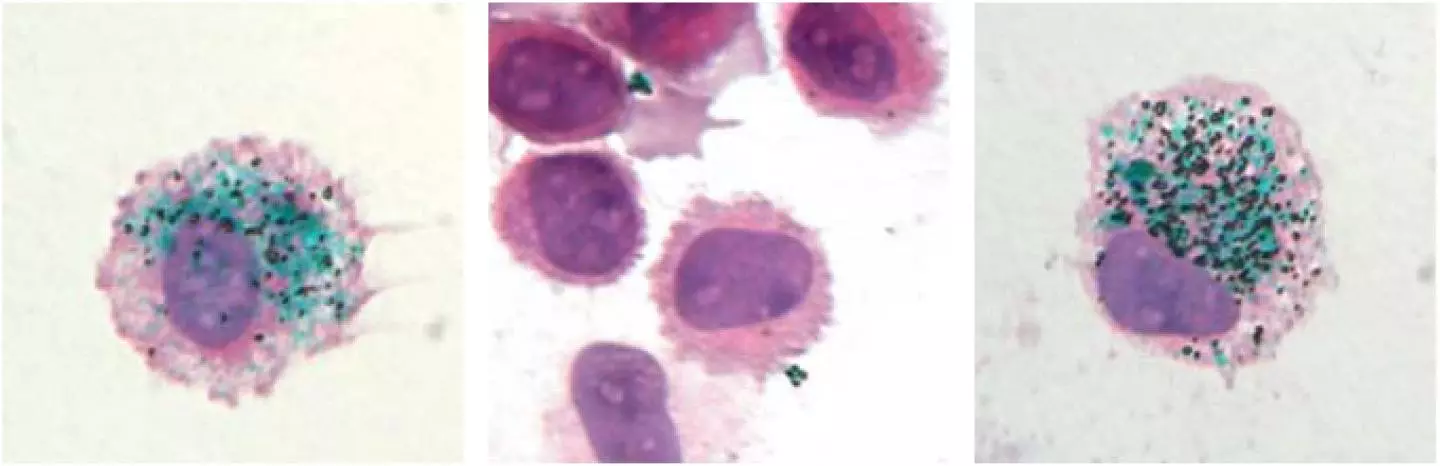 Green tattoo pigment is taken up by dermal macrophages (left). The pigment is released when these cells are killed (center) but, 90 days later, is taken back up into new macrophages that have replaced the old ones (right)