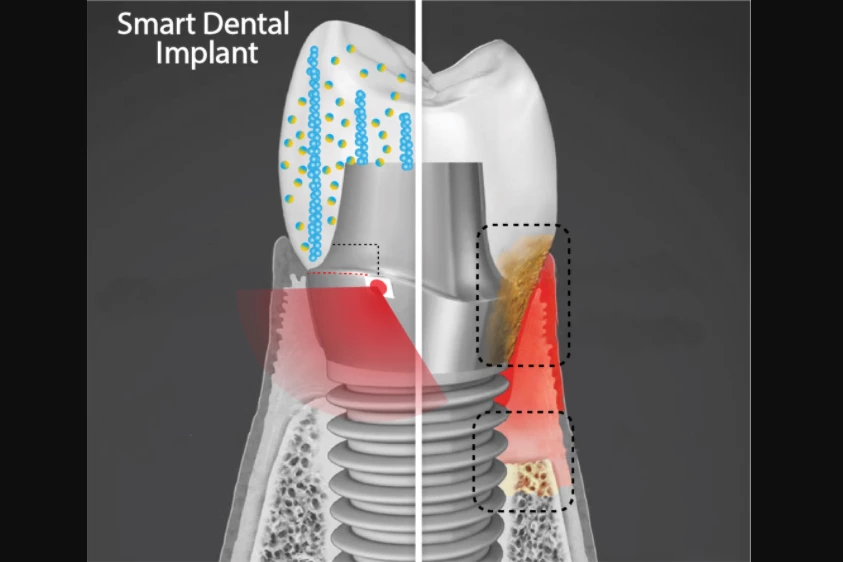A cut-away diagram of the Smart Dental Implant (SDI), which does exist as a physical proof-of-concept prototype