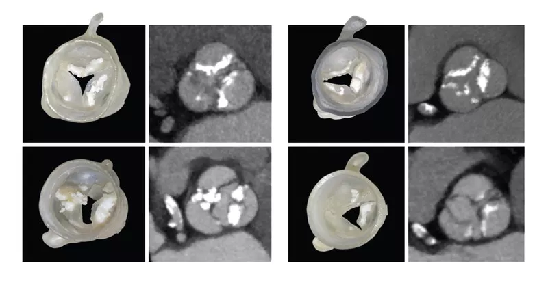3D-printed models of individual heart valves along with CT models on which they are based