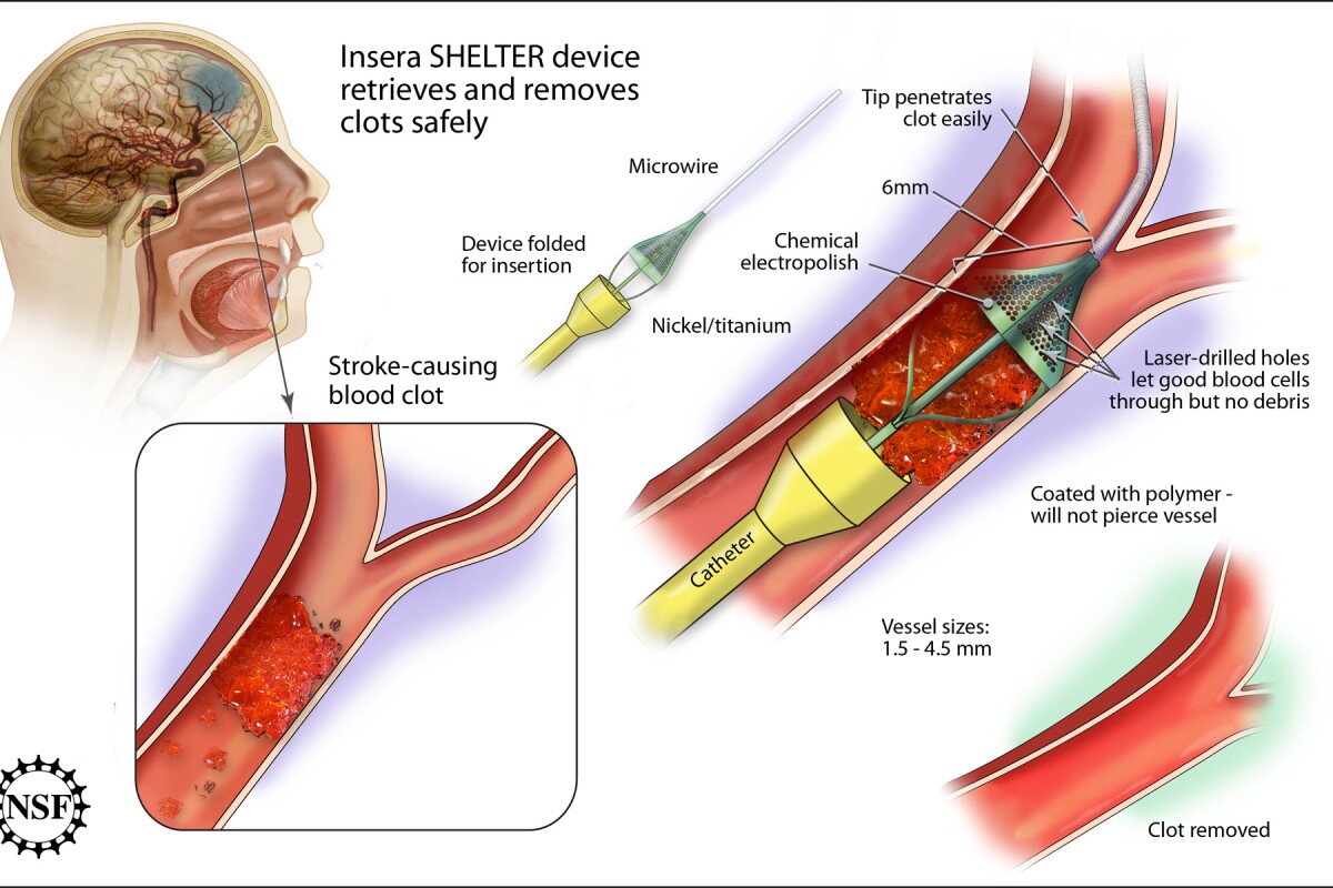 SHELTER device traps and removes blood clots in the brainCredit: Zina Deretsky, NSF