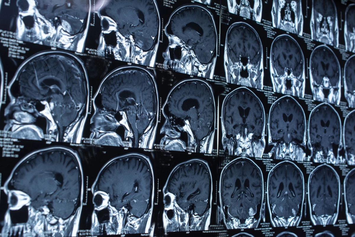 Scientists trained an AI to spot lesions in CT scans of human brains