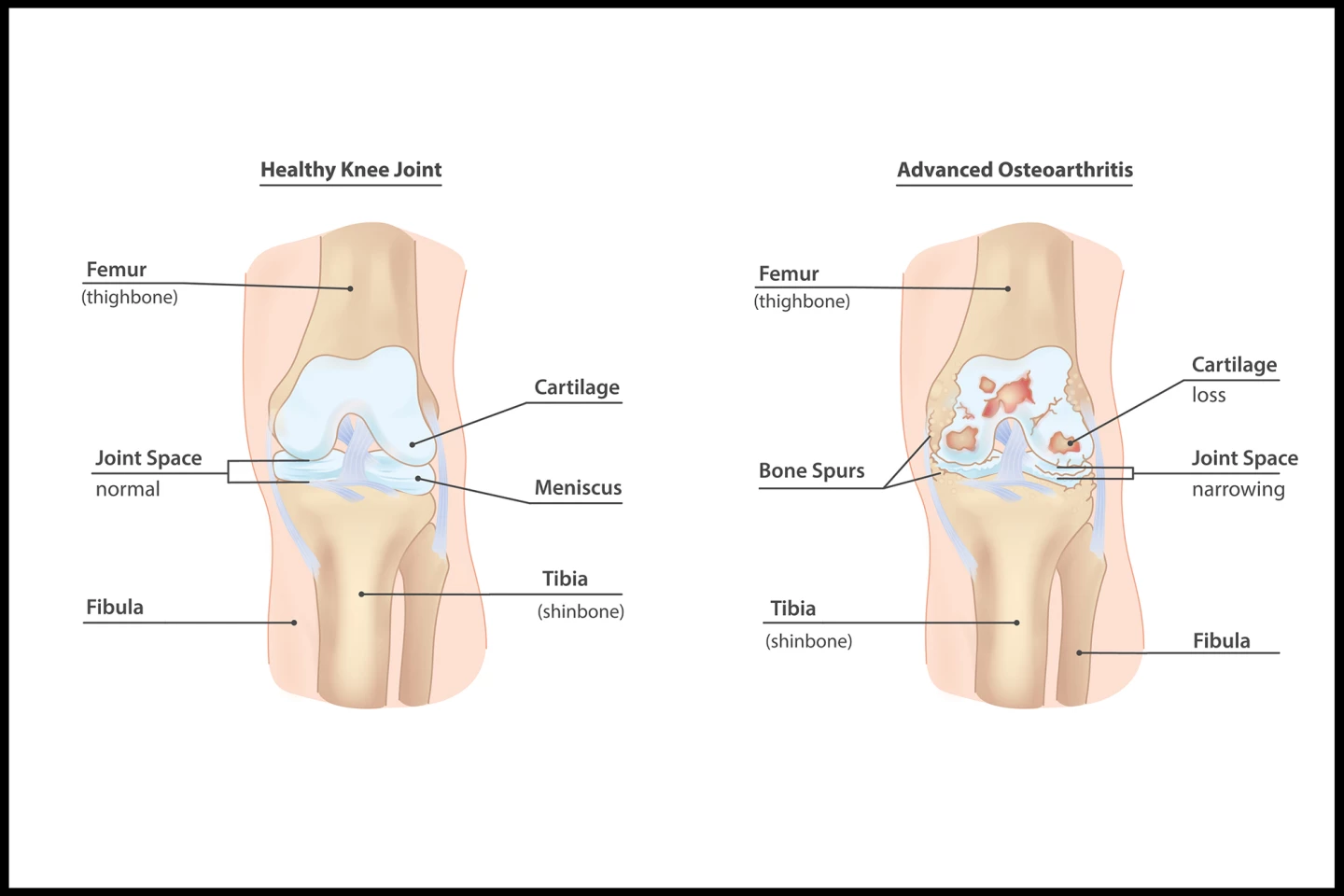 Healthy knee anatomy and anatomy in advanced OA