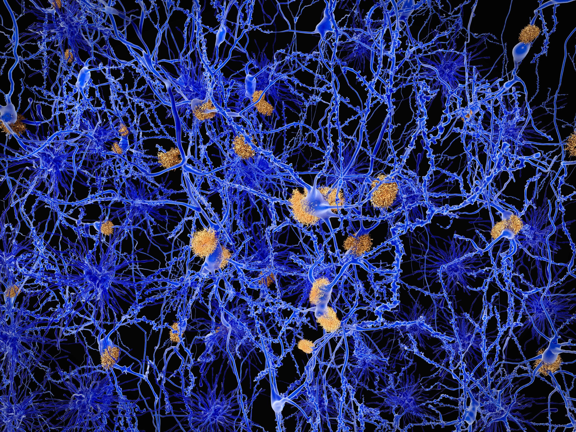 An ongoing long-term trial suggests high levels of amyloid proteins in the brain do serve as an early sign of Alzheimer's disease before cognitive decline becomes apparent