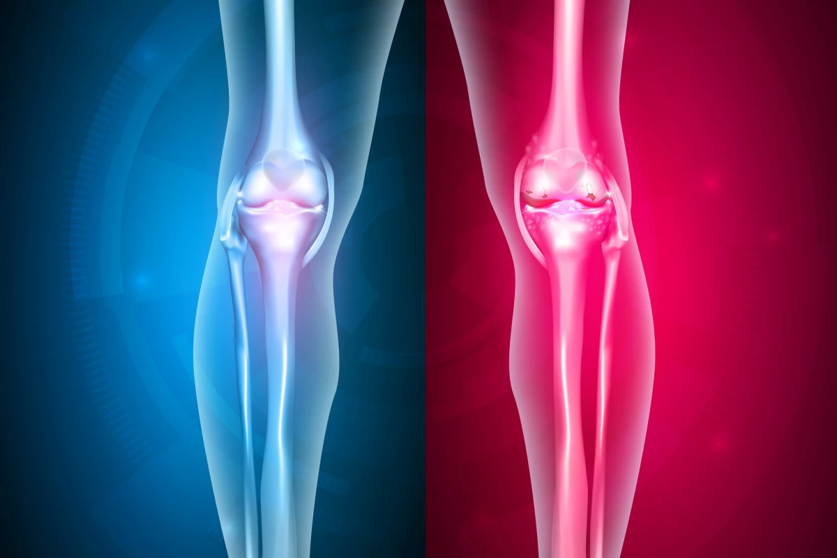 While it's rare, infections from joint replacements still affect hundreds of thousands of people a year
