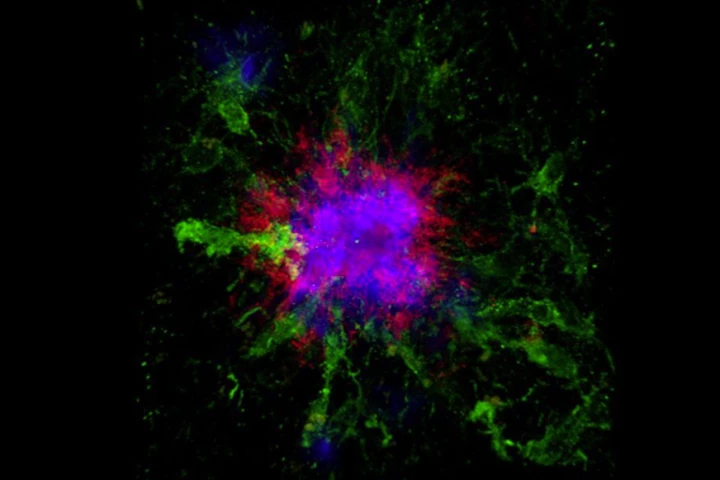 This confocal microscopy image shows amyloid plaques (blue and red) in the brain of a mouse – the accumulation of amyloid plaques is so far the most well-documented biochemical hallmark of Alzheimer’s disease